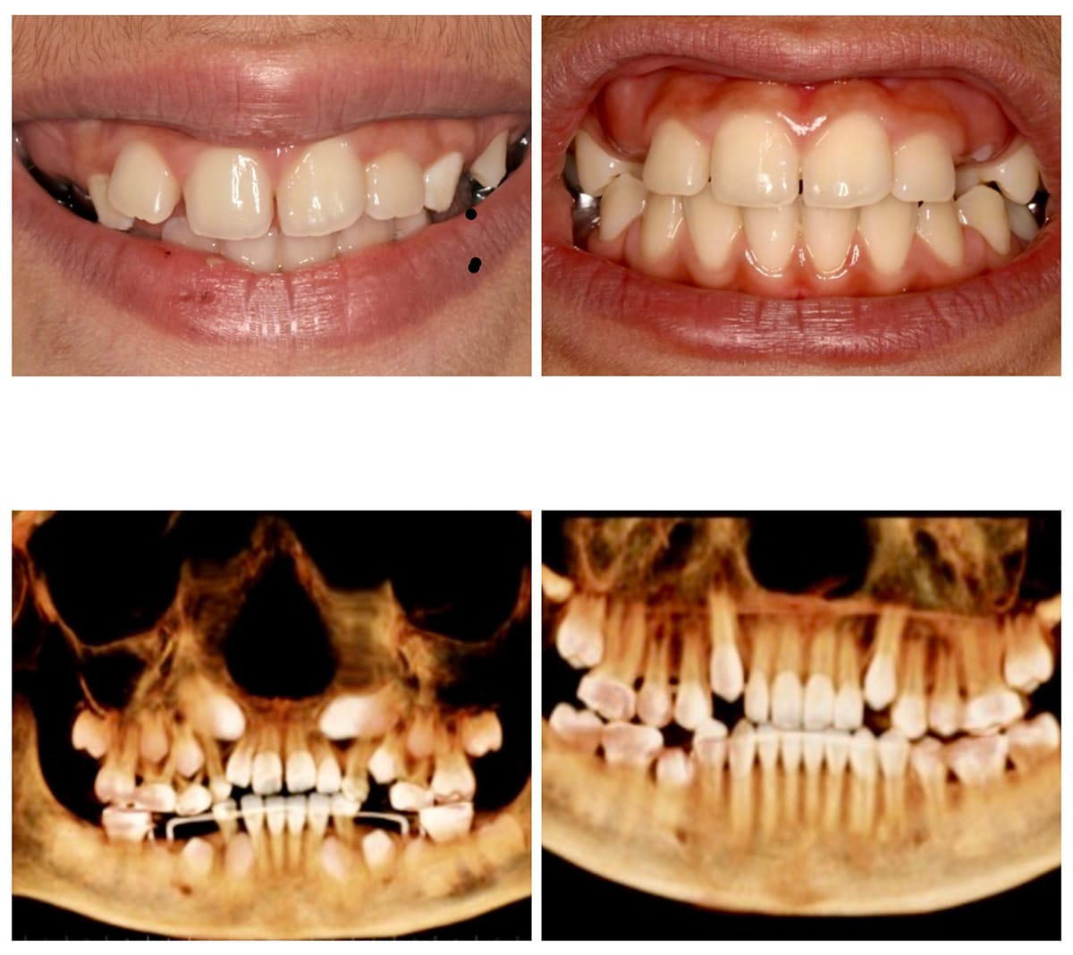 Straight teeth naturally